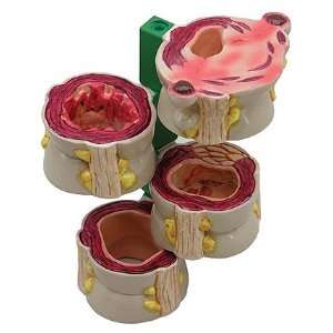 Four Piece Colon with Pathologies Model  Industrial 